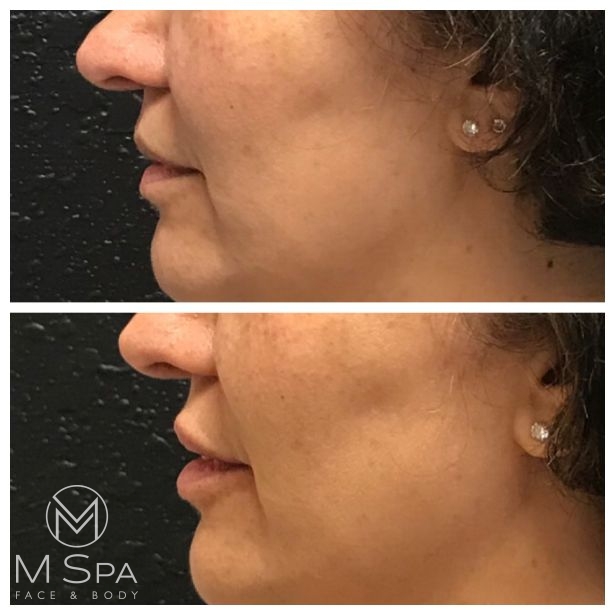 lip injections female side view before and after