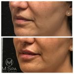 lip injections female left angle view before and after