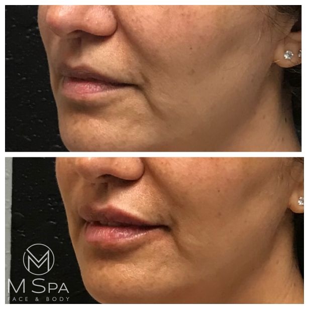 lip injections female left angle view before and after