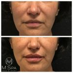 lip injections female front view before and after