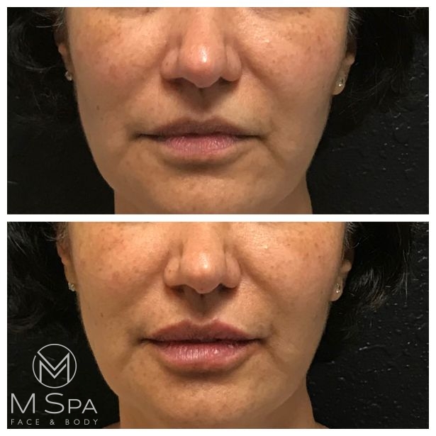 lip injections female front view before and after