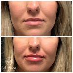 lip injections front view before and after
