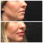 lip injections right angle view before and after