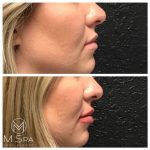 lip injections side view before and after