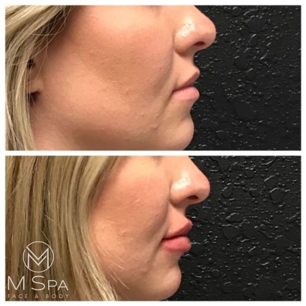 lip injections side view before and after