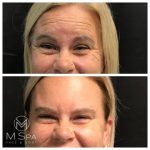 dysport crows feet and forehead treatment before and after