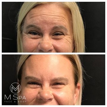 dysport crows feet and forehead treatment before and after