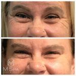 dysport crows feet treatment before and after