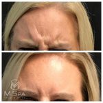 dystport female forehead treatment before and after
