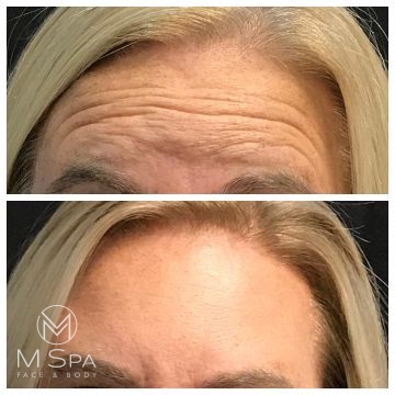 dysport forehead treatment before and after